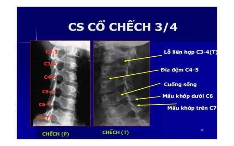 DẤU HIỆU CẢNH BÁO THOÁT VỊ ĐĨA ĐỆM CỘT SỐNG CỔ