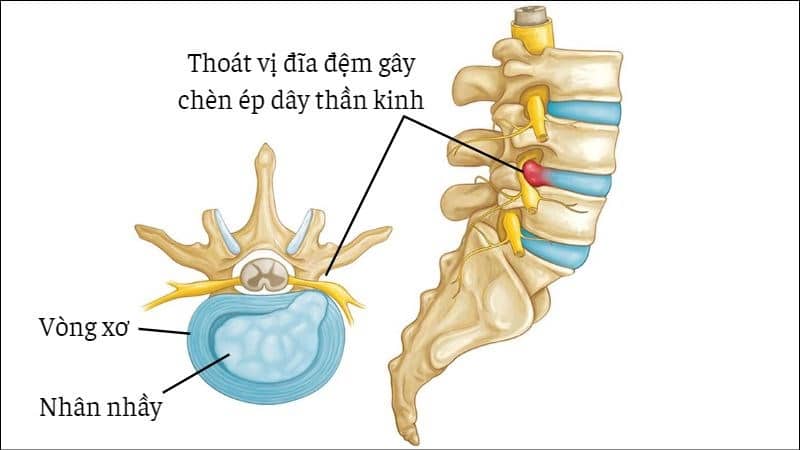 TỔNG QUAN VỀ THOÁT VỊ ĐĨA ĐỆM - HIỂU ĐÚNG ĐỂ TRỊ ĐÚNG