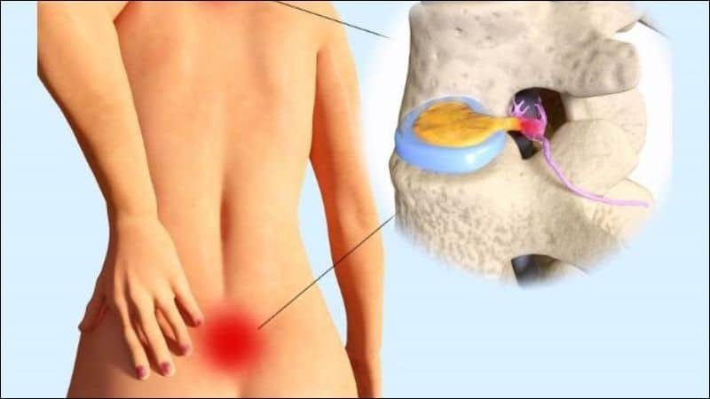 TỔNG QUAN VỀ THOÁT VỊ ĐĨA ĐỆM - HIỂU ĐÚNG ĐỂ TRỊ ĐÚNG